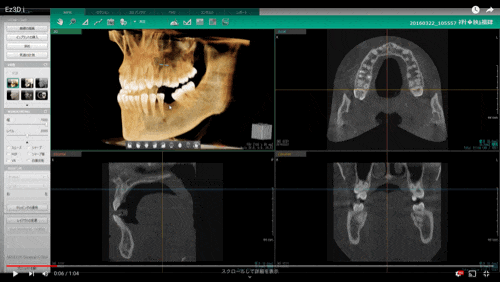 最新のアイテロ、セファロ分析、CTによる診断